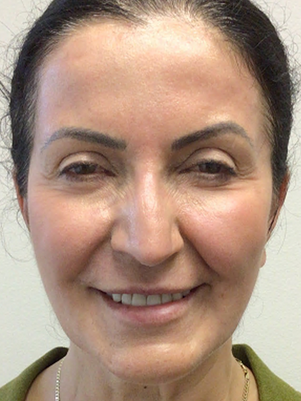 Laser Resurfacing Before and After 03