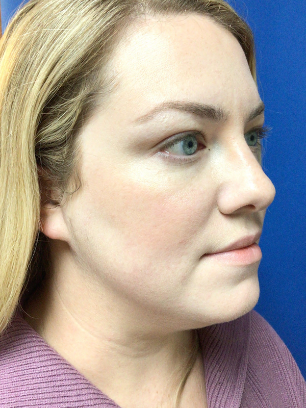 Laser Resurfacing Before and After 02