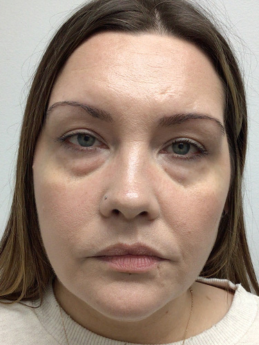 Laser Resurfacing Before and After 03