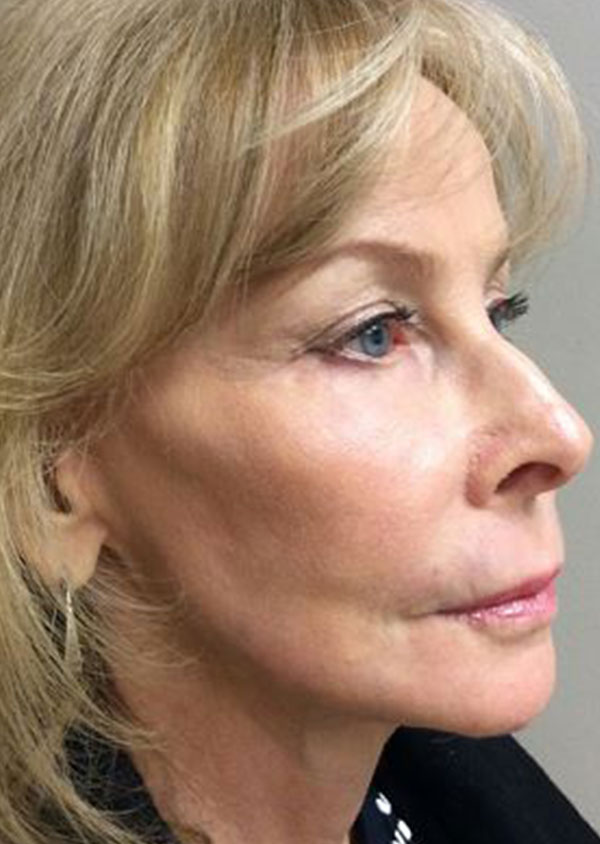 Laser Resurfacing Before and After 05