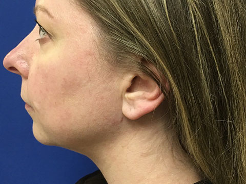 Laserlift Before and After 10