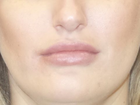 Lip Augmentation Before and After 06