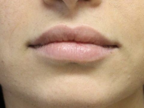 Lip Augmentation Before and After 05