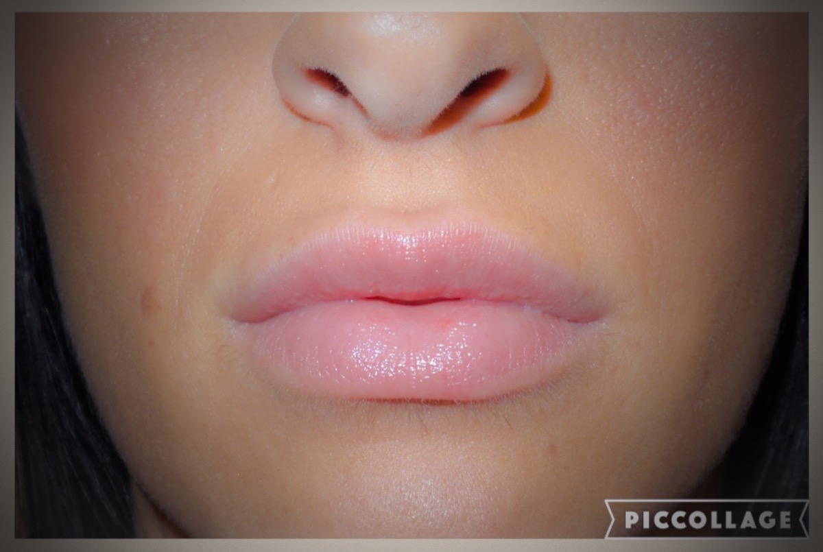 Lip Augmentation Before and After 08