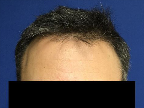 Hair Issues Michigan | Accents Cosmetic Surgery