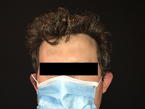 Neograft For Men Before and After 03