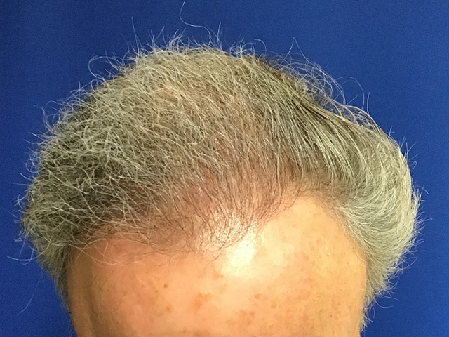 Neograft For Men Before and After 13
