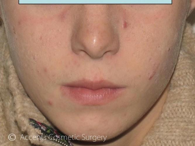 Acne Treatments Michigan