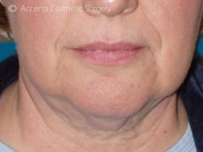 Thermage Face And Neck Before and After 02