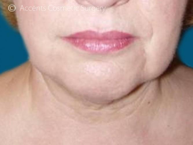 Thermage Face And Neck Before and After 04