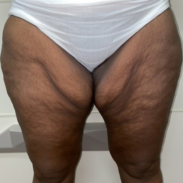 Thigh Lift Before and After 01