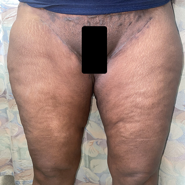 Thigh Lift Before and After 01