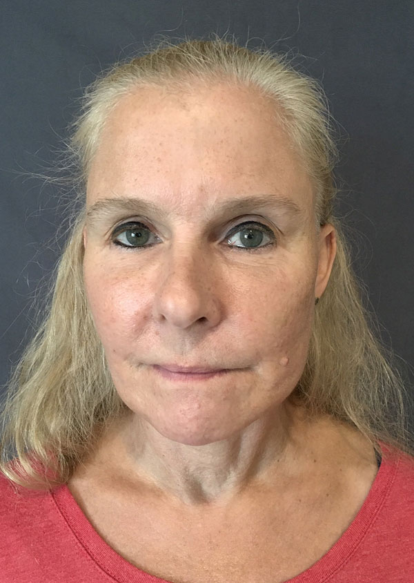 Threadlift Facelift Before and After 01