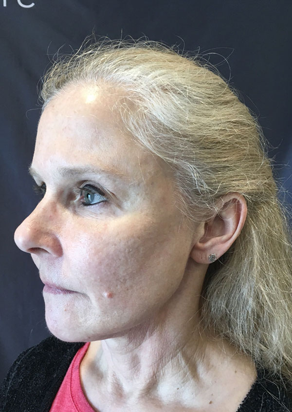 Threadlift Facelift Before and After 02