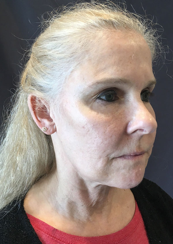 Threadlift Facelift Before and After 02