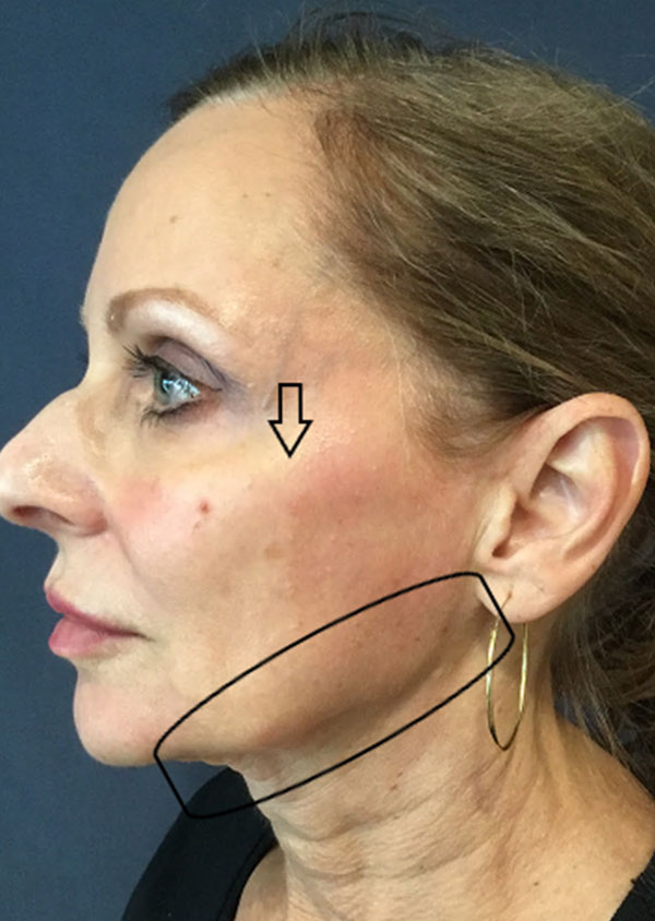 Threadlift Facelift Before and After 03