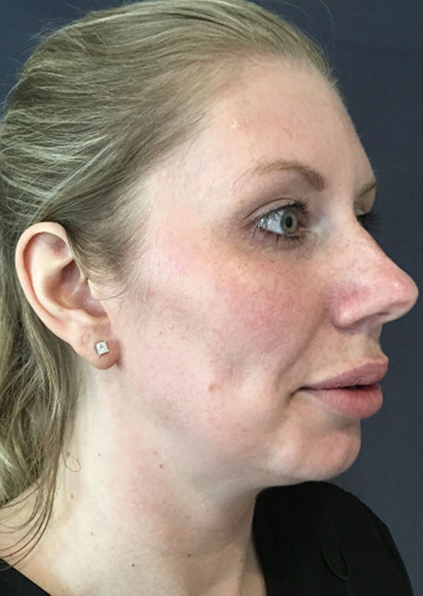 Threadlift Facelift Before and After 04