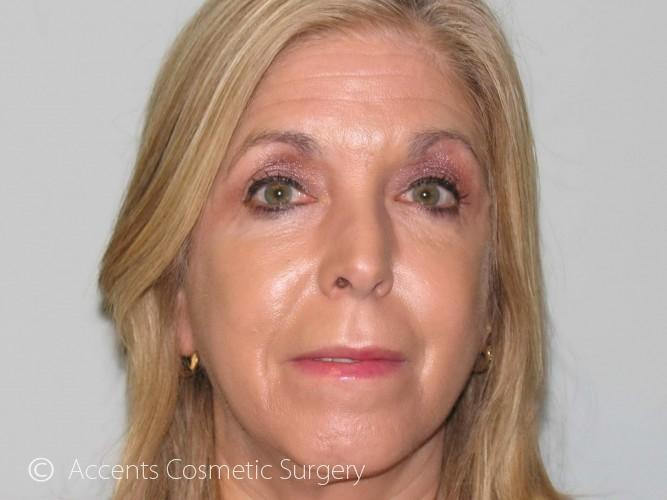 Vampire Facelift Before and After 01